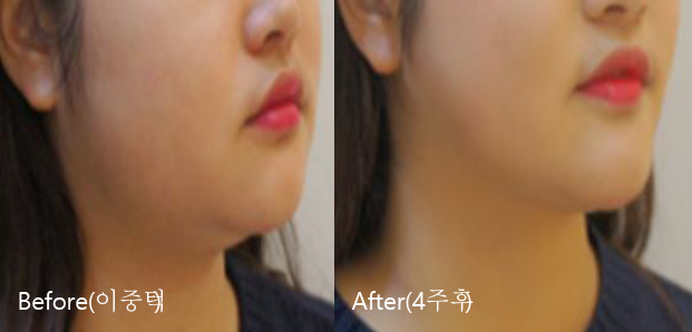 BeforeAfter_VFacialContouring01