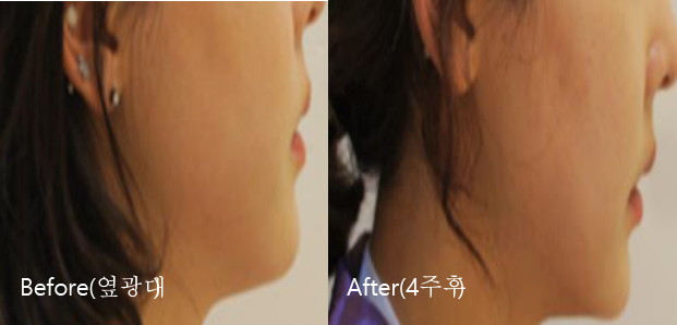 BeforeAfter_VFacialContouring02