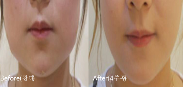 BeforeAfter_VFacialContouring03