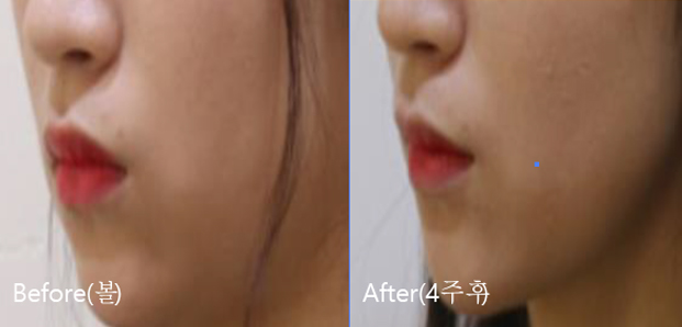 BeforeAfter_VFacialContouring04