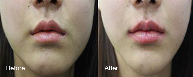 BeforeAfter_VFacialContouring05n