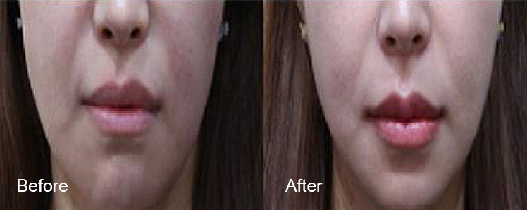 BeforeAfter_VFacialContouring06n