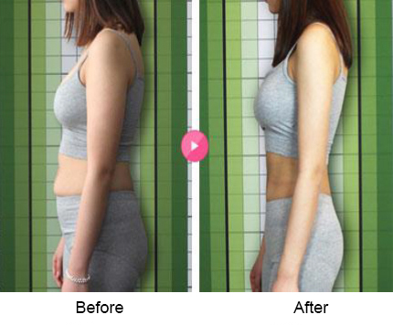 BeforeAfter_bodyslim05n