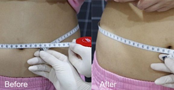BeforeAfter_bodyslim02n