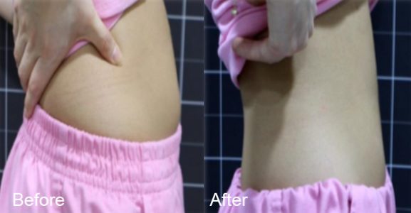 BeforeAfter_bodyslim04